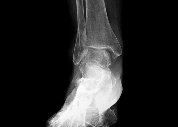 ankle-fracture